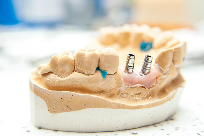 Dental Implants: Are They Safe?