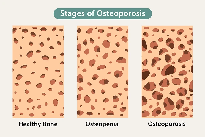How Do You Treat Osteopenia?